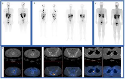 Case Report: Re-Treatment With Lu-DOTATATE in Neuroendocrine Tumors